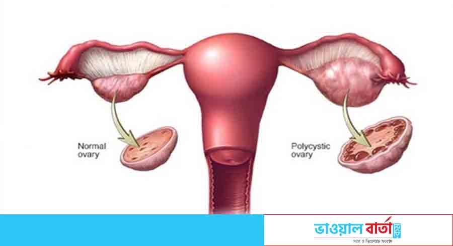 পলিসিস্টিক ওভারিয়ান সিনড্রোম ও এর লক্ষণ